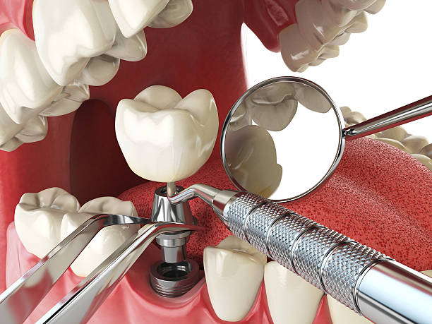 Best Broken or Cracked Tooth Emergency Dentist in Palm City, FL